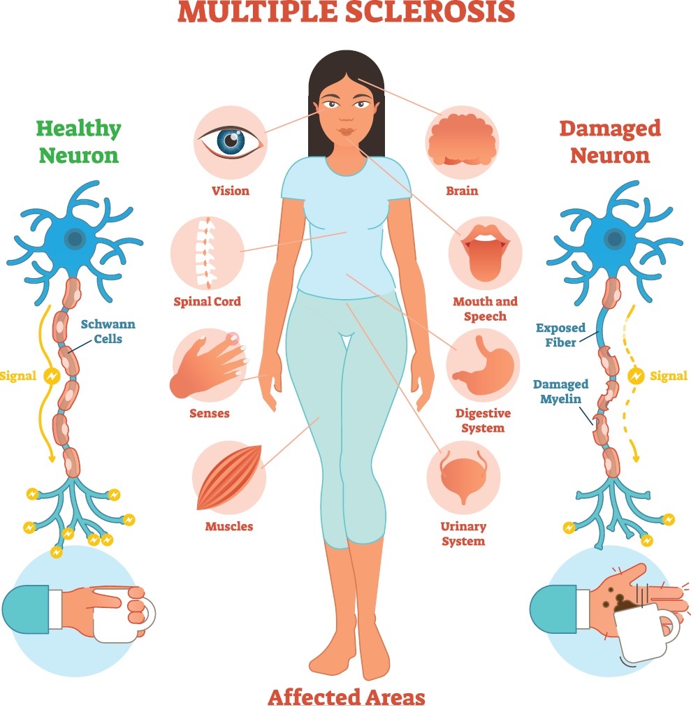 multiple sclerosis affected areas 1